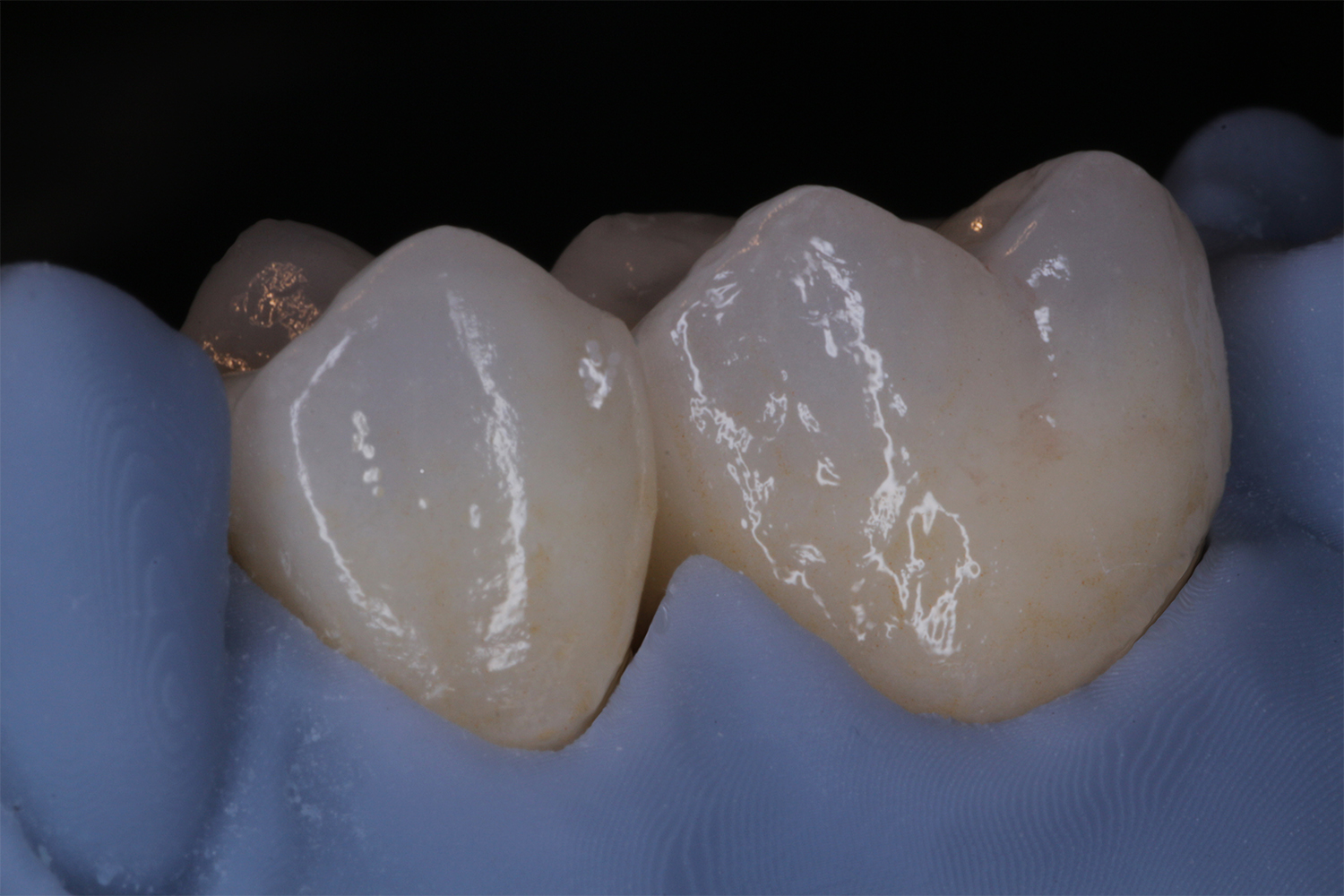 lucrare dentala asimetric